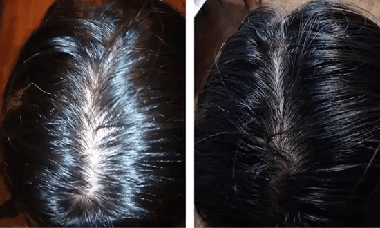 The result of using a laser cap to prevent hair loss