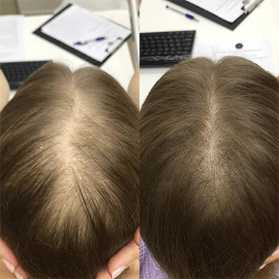 The result of the Capillus laser cap for the treatment of hair loss
