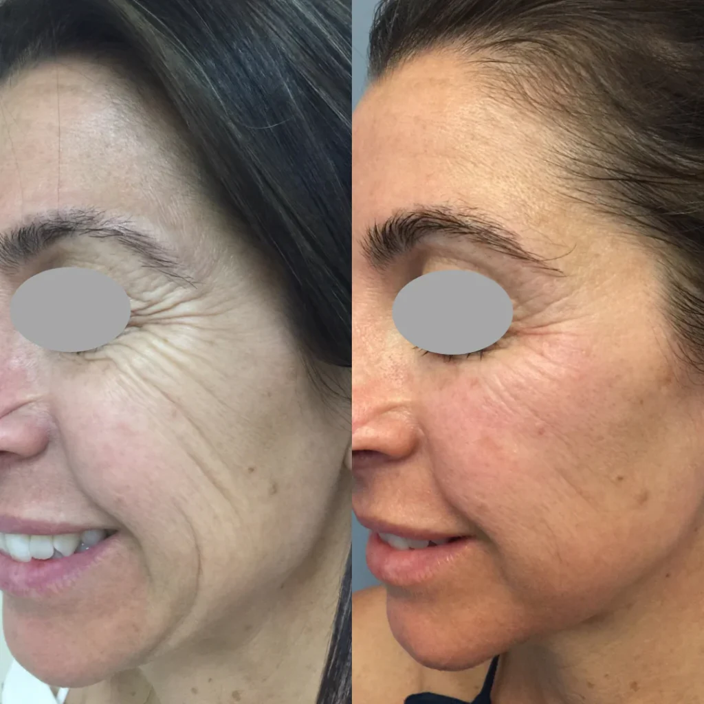 The result of using Forma Facial for ten sessions