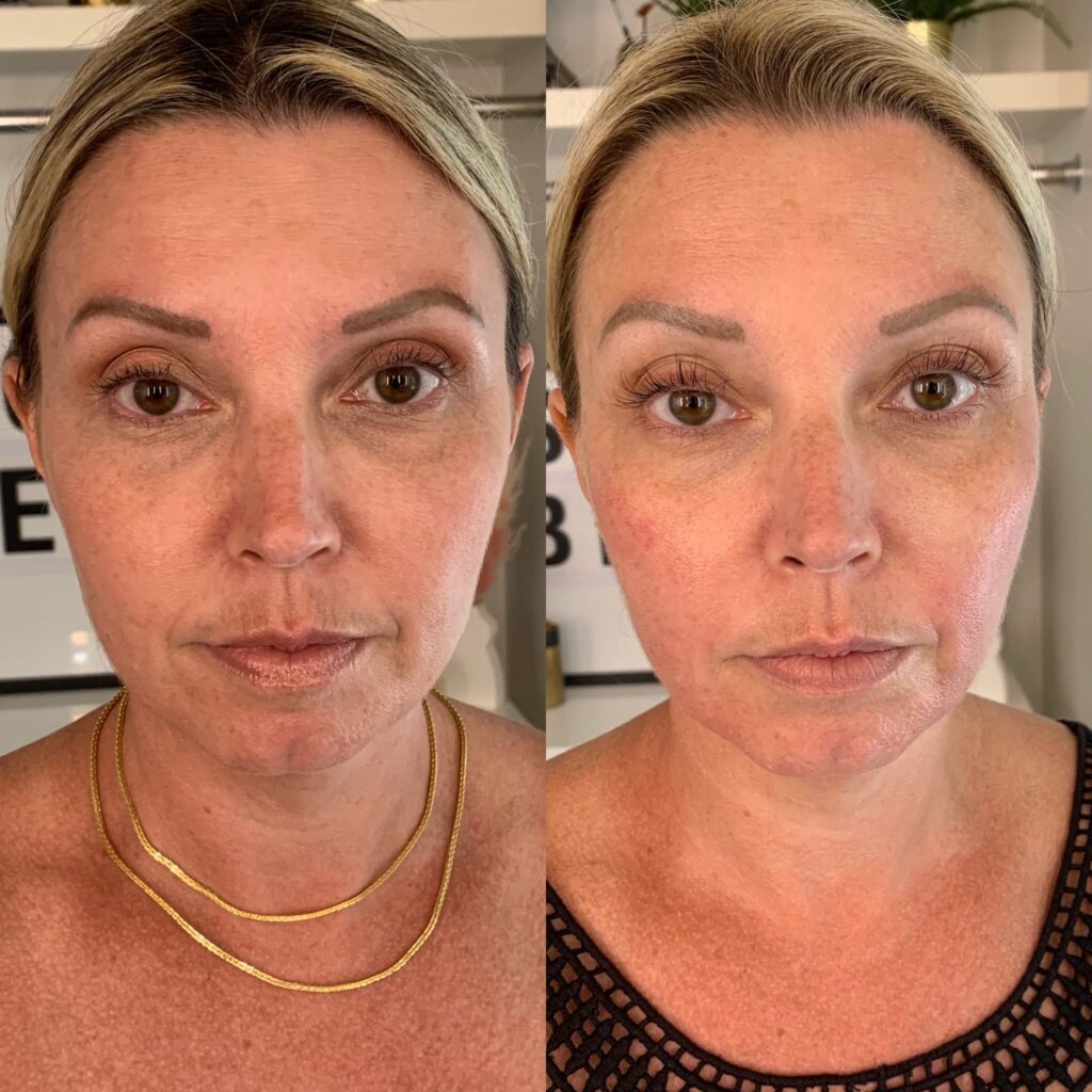 Result of six treatments with Forma Facial