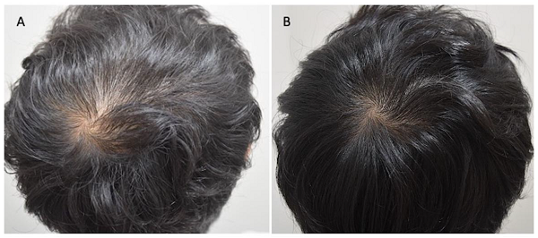 The result of using the LLLT system for hair loss treatment