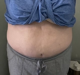 A girl got rid of a lot of extra pounds with Nushape Lipo Wrap for 3 months (combined with proper diet and exercise)
