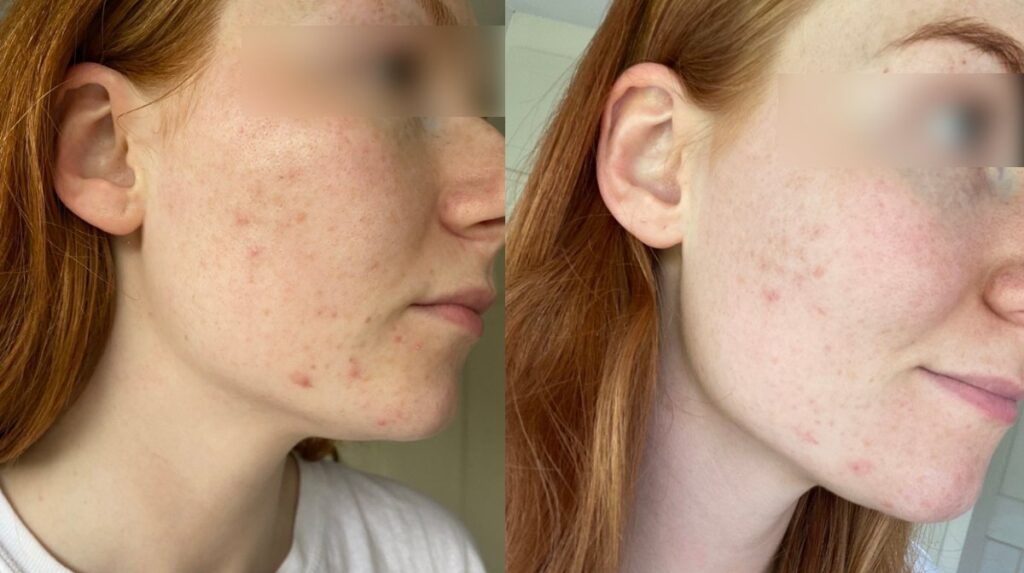 The result of Lux Collection Glō for acne treatment
