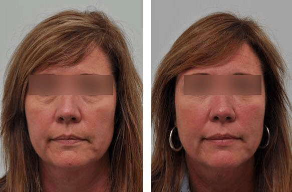 The result of using reVive light therapy for anti-aging (after 4 weeks)