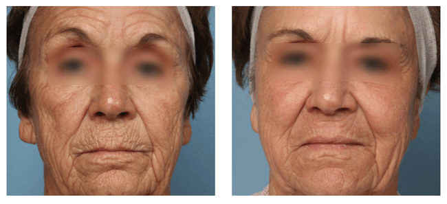 The result of using reVive light therapy for anti-aging (after 8 weeks)