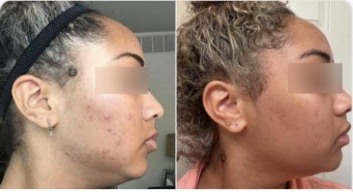 The result of using the NuDerma Professional for acne treatment