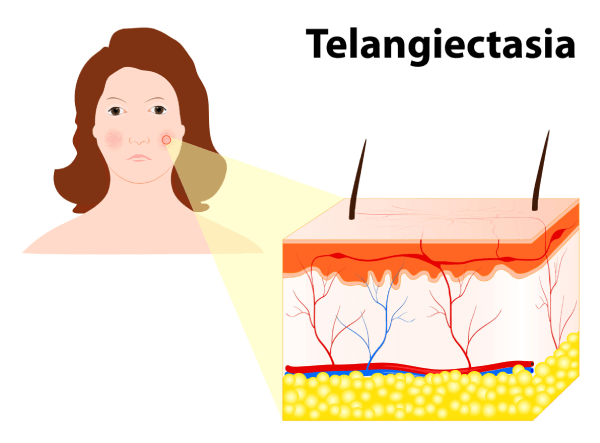 Example of broken capillaries under the skin