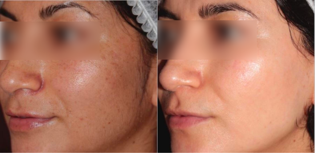 The result of Lux Collection Glō for acne treatment
