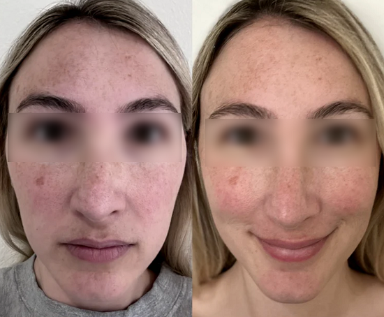 The result of using the Solawave red light therapy for 2 weeks