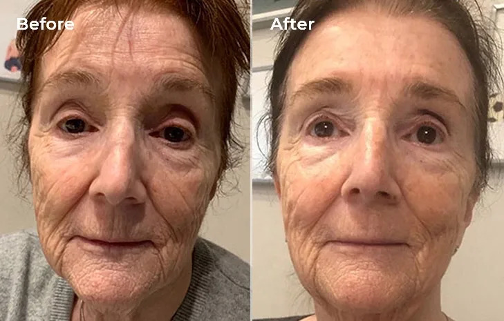 Results of reducing wrinkles on the chin and around the mouth, improving overall skin tone and elasticity, brighter complexion after 4 months of laser treatment