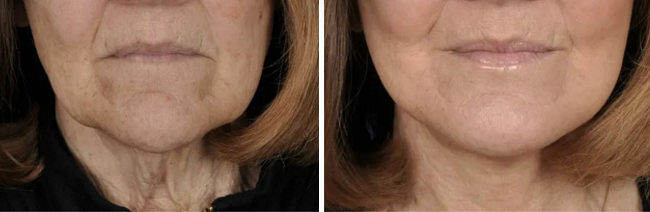 The result of using the NuDerma Standard for anti-aging 