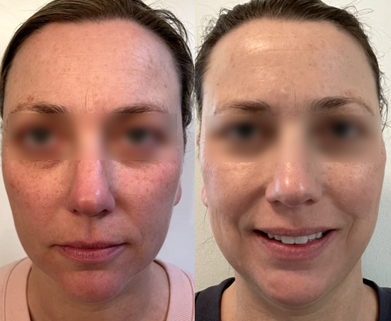 The result of using the Solawave red light therapy for 2 weeks