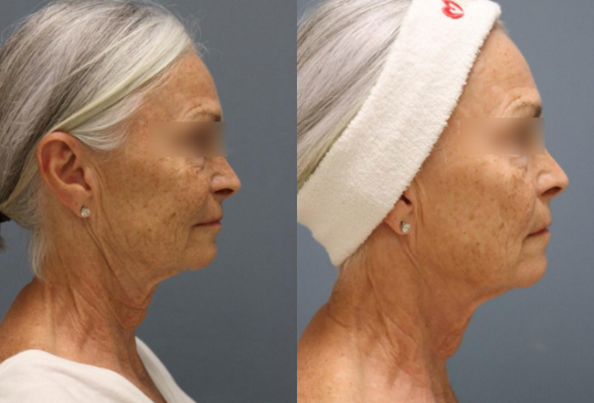 The result of using high-frequency device for anti-aging