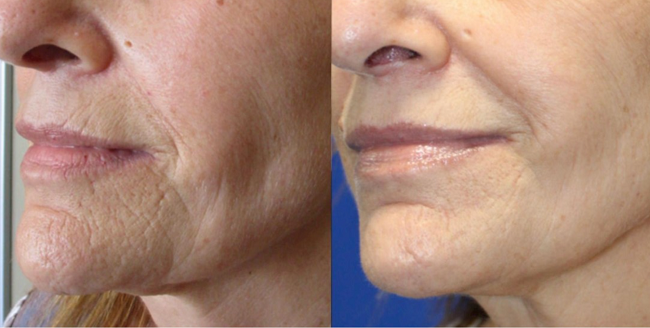 The result of using the NuDerma Clinical for anti-aging 