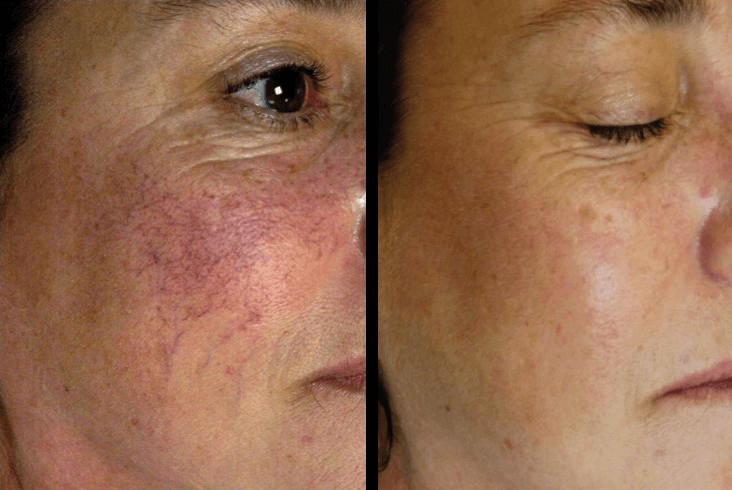 Results of using the laser to fight broken capillaries within 6 months