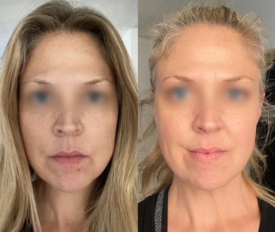 The result of using the Solawave red light therapy for 3 weeks