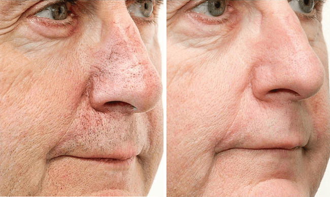 Results of using the laser to fight broken capillaries in 7 sessions 