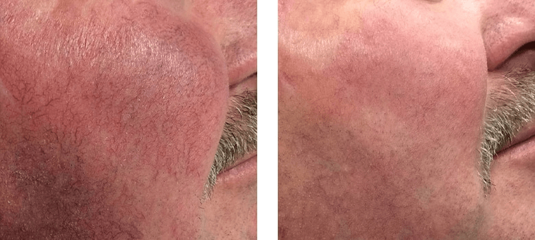 Results of using the laser to fight broken capillaries within 3 months