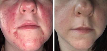 The result of using the NuDerma Clinic for acne treatment