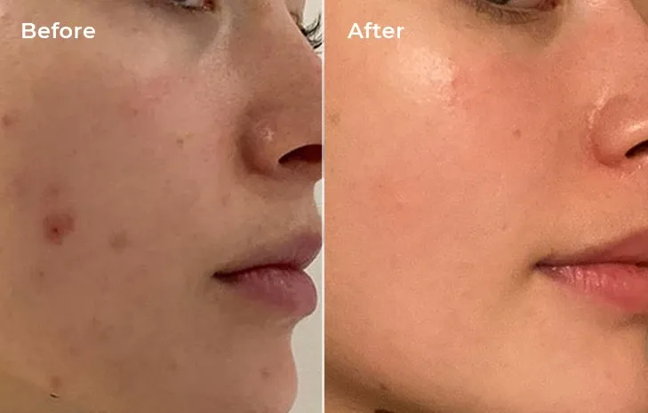 Result of getting rid of acne scars within 4 weeks of using the laser