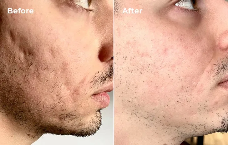 Improvement and smoothing of skin texture after 3 months of laser use