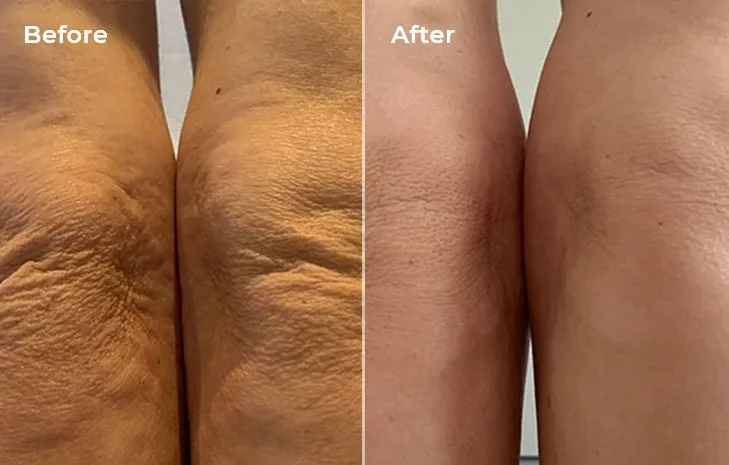 Results of significant improvement in skin texture, elasticity, and cellulite reduction within 3 months of use