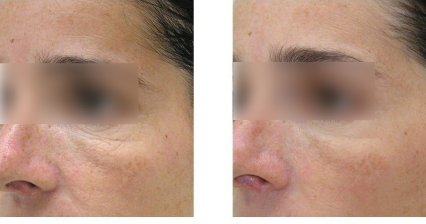 The result of using red and infrared light therapy for anti-aging
