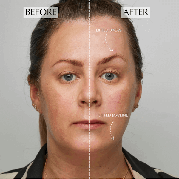 The results of using Ziip Halo to tighten eyebrows, cheeks and jawlines