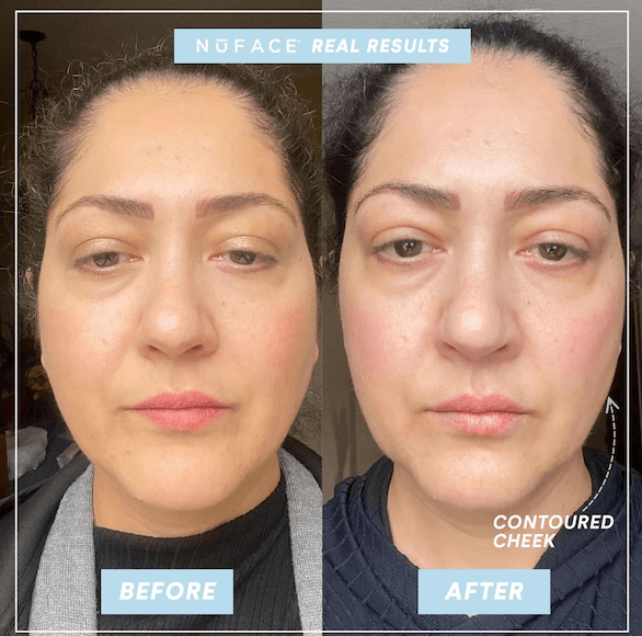 The significant results of using NuFace Trinity to improve face lines