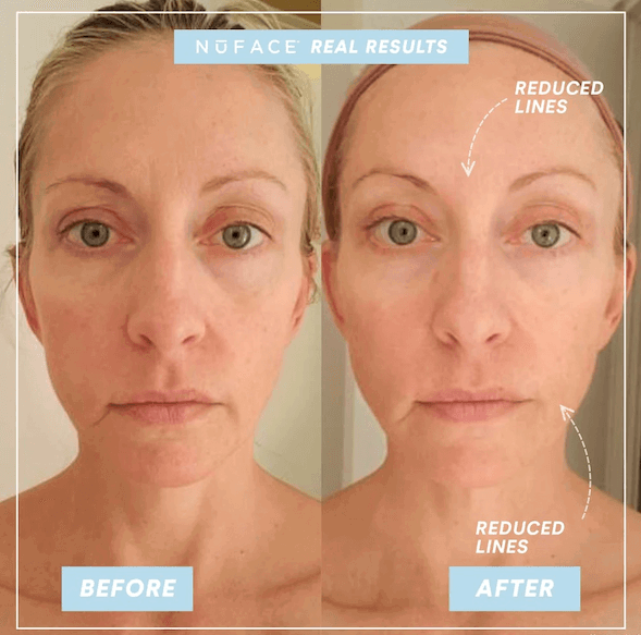 The significant results of using NuFace Trinity to improve face lines