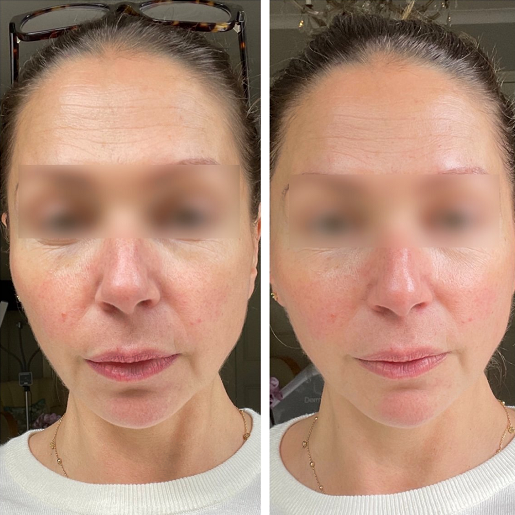 The result of using the high frequency machine for anti-aging (after 2 weeks)