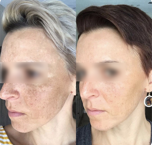 The result of using the high frequency machine for hyperpigmentation (after 3 weeks)