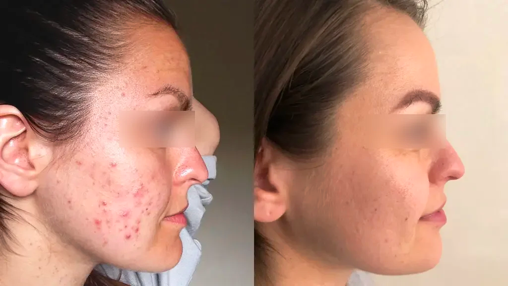 The result of using the high frequency machine for acne treatment