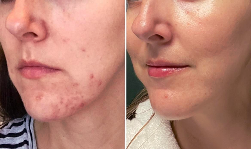 The result of using the high frequency machine for acne (after 4 weeks)