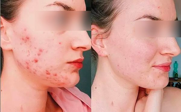 The result of using the high frequency machine for acne (after 8 weeks)