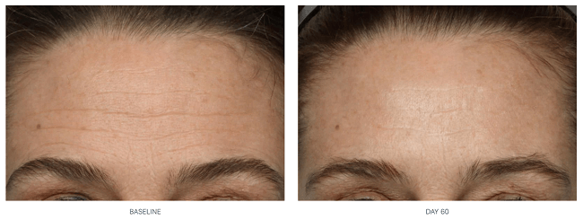 The result of using NuFace for forehead wrinkle reduction