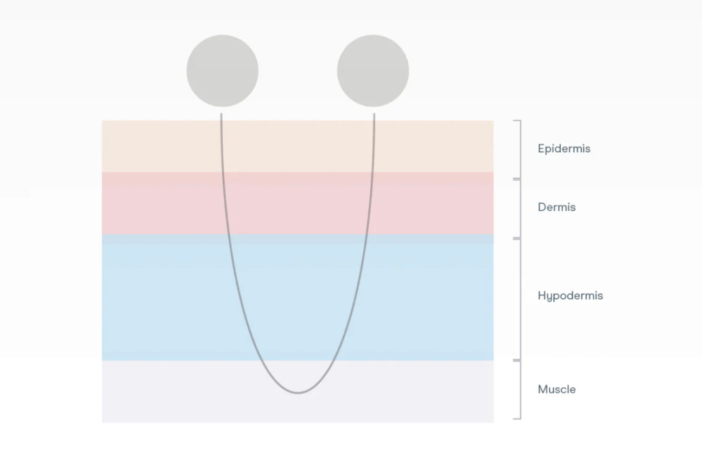 Depth of penetration of microcurrent therapy into the skin