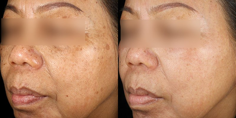 NuDerma high-frequency wand before and after result for anti-aging (after 6 weeks)