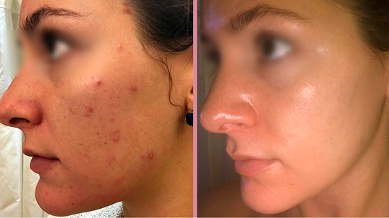 NuDerma high-frequency wand before and after result for acne treatment (after 8 weeks)
