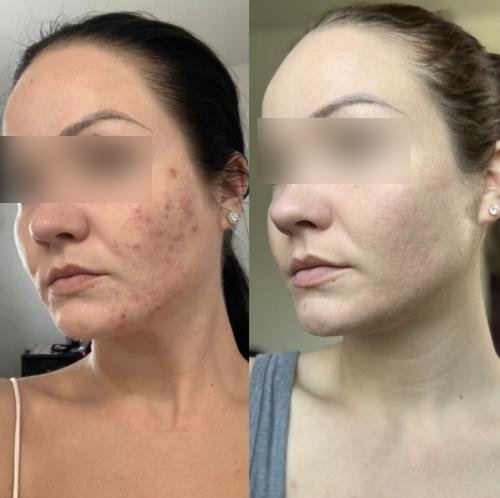 NuDerma high-frequency wand before and after result for acne treatment (after 6 weeks)