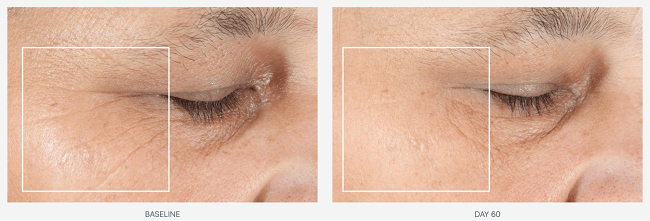 The result of using NuFace for reducing crow's feet and eye wrinkles