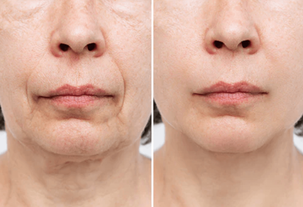 The result of using microcurrent treatment for reducing wrinkles and fine lines 