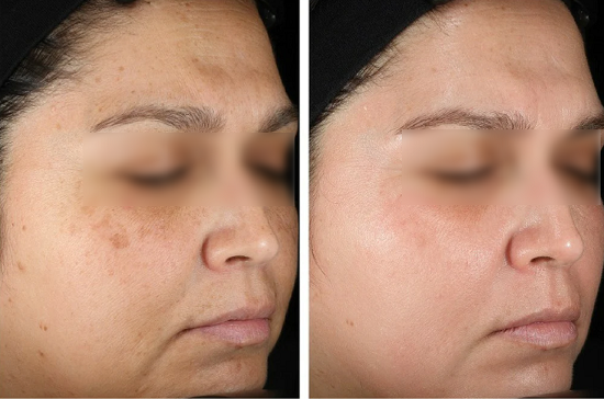 NuDerma high-frequency wand before and after result for anti-aging (after 4 weeks)