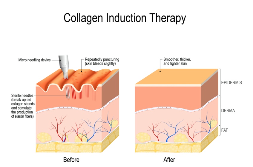 Collagen induction therapy (microneedling)