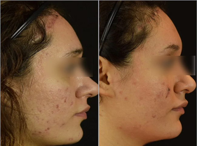 The result of using microneedling for acne scars