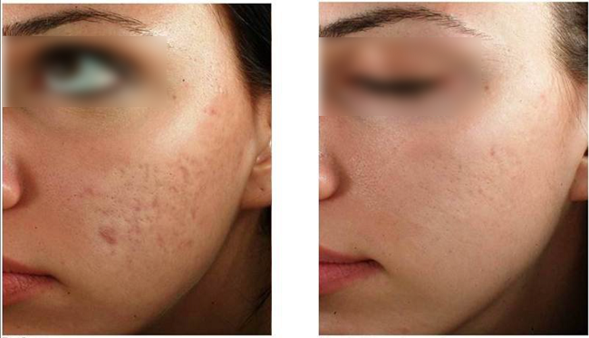 The result of using microneedling for acne scars