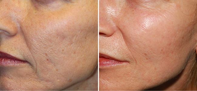 The result of using microneedling for wrinkles