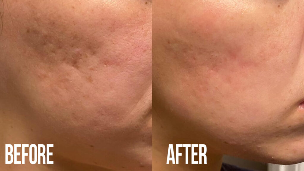 Visible changes for acne scar treatment after microneedling